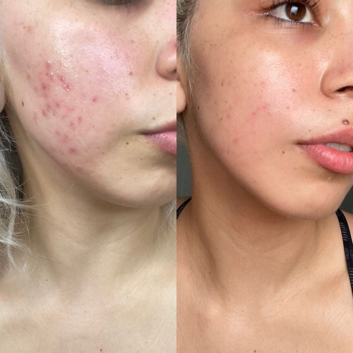 LED Licht Therapie Maske