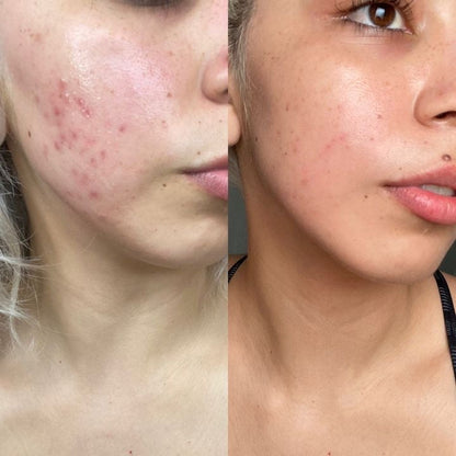 LED Licht Therapie Maske