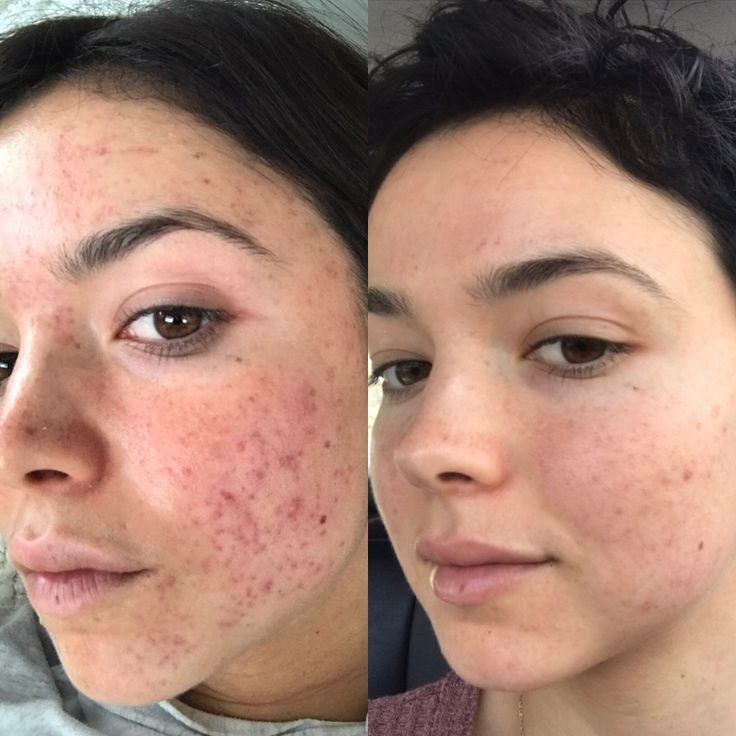 LED Licht Therapie Maske